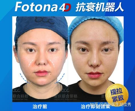 fotona4d碾压热玛吉你知道吗