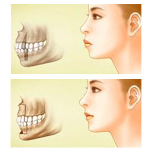 而嘴突需要分为骨性前突和牙性前突,骨性前突可能就需要动刀子了