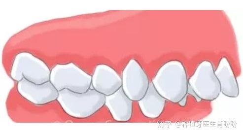02,严重闭锁型深覆合,会经常咬伤上排前牙靠上颚一侧的牙龈或下排前