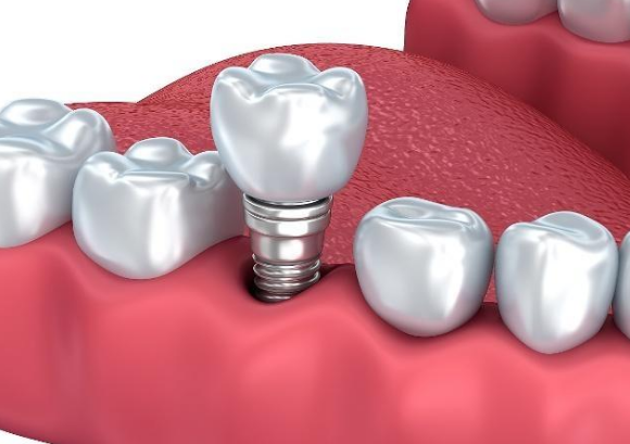 解答各类牙科知识      种植牙作为目前牙齿缺失的有效修复技术