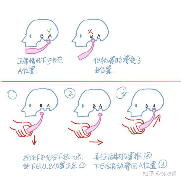 下巴脱臼了怎么自救