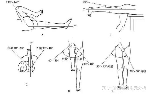 髋关节假体设计,cae仿真帮大忙