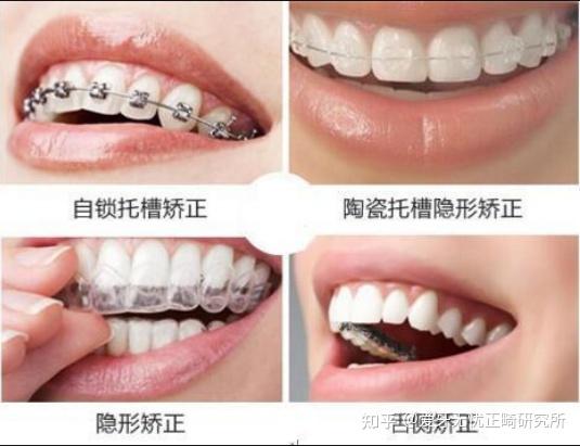 350000-50000  舌侧隐形牙套:50000-80000  注:以上价格为矫正的合计
