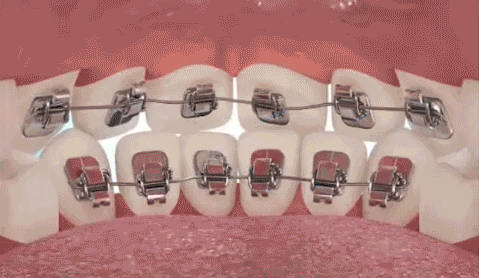 牙齿矫正的原理是什么?对牙齿神经会有负面影响吗?