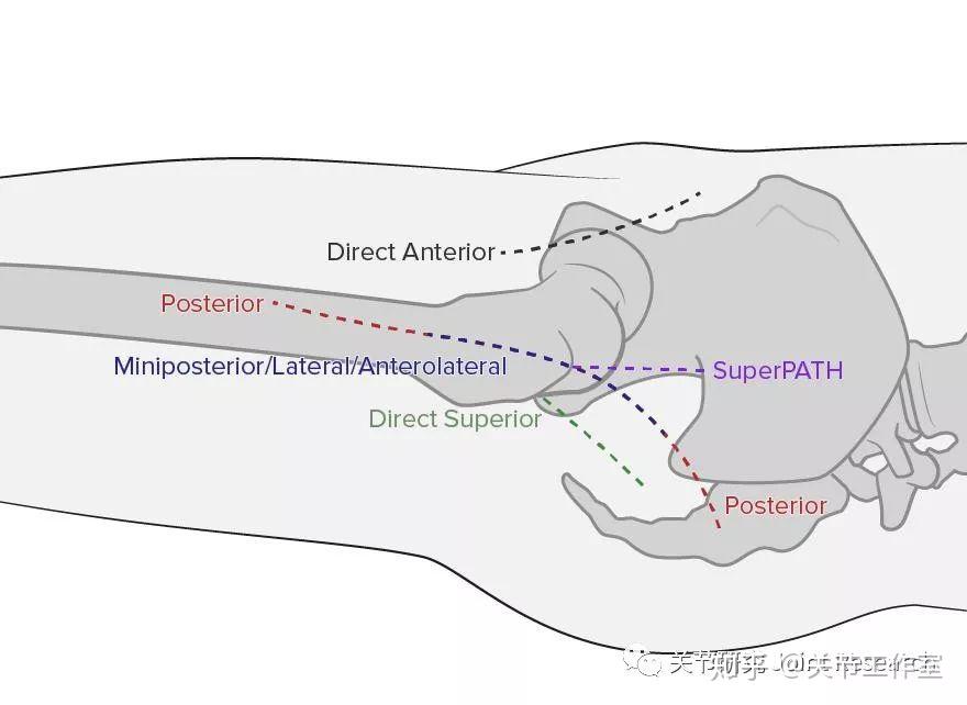 全髋关节置换的入路种类 髋关节周围切口就那么几个