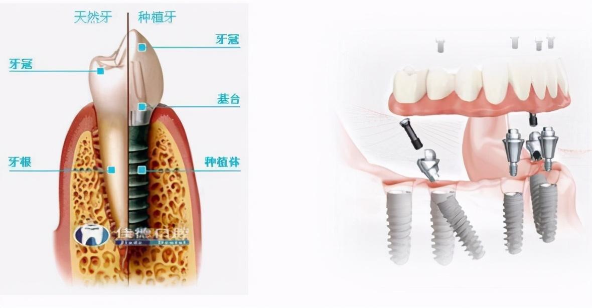 图68种植牙结构示意图数据来源:东兴证券研究所,大博医疗公司种植体