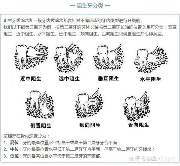 福利一:阻生齿拔牙分类及建议