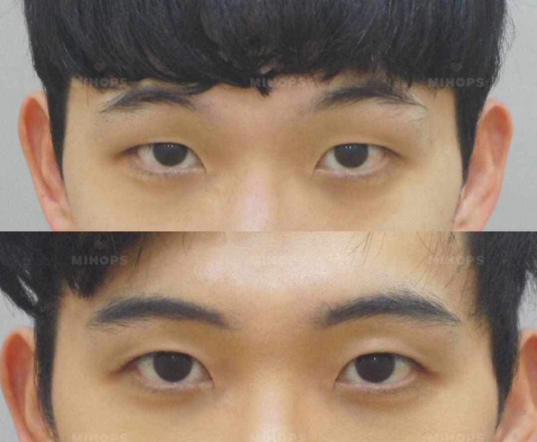 为什么韩国人的单眼皮这么好看,单眼皮不用做双眼皮变
