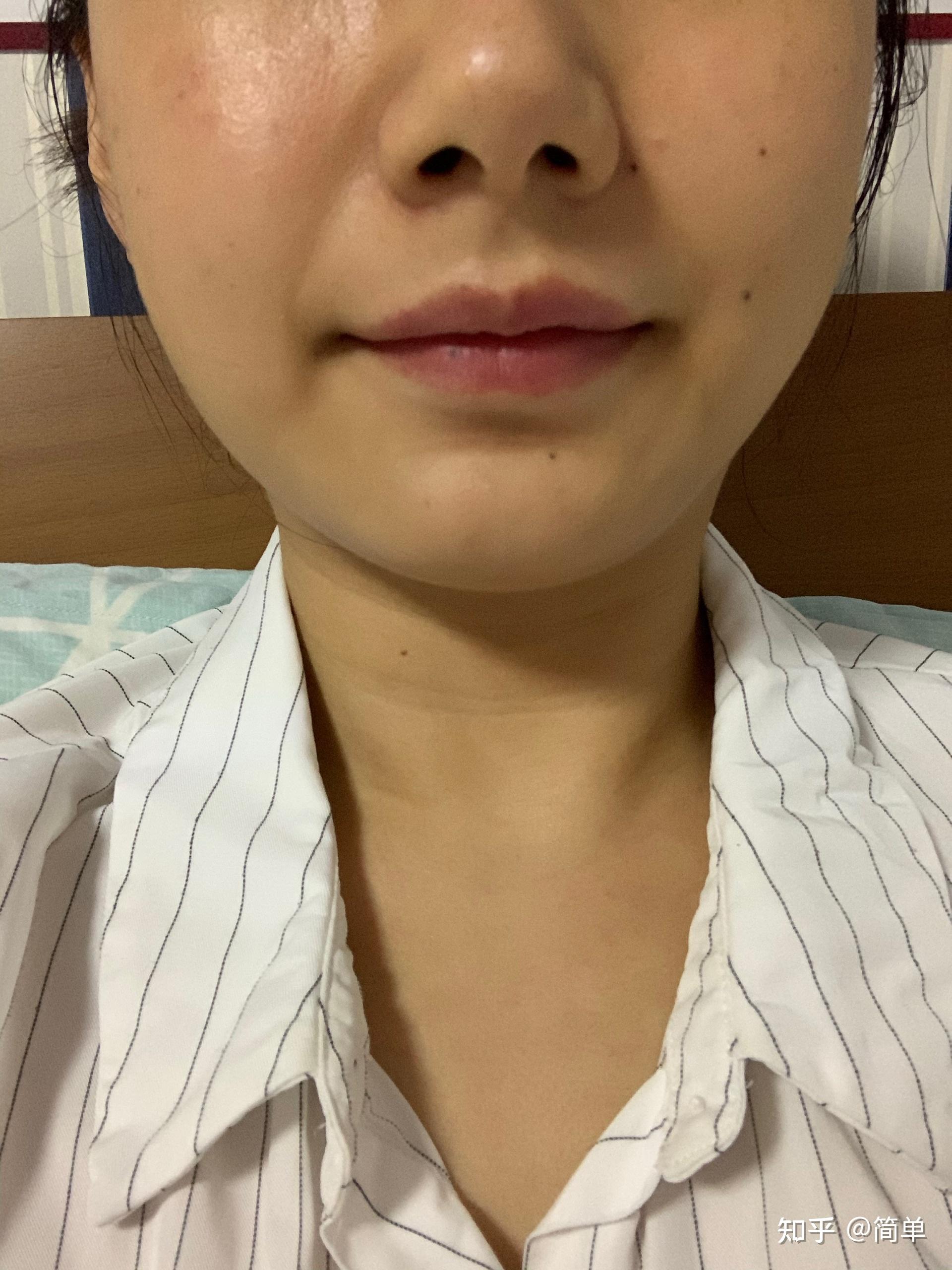 为什么嘴巴两边嘴角会有凸出来的肉肉看整体面相的话比看这个局部更