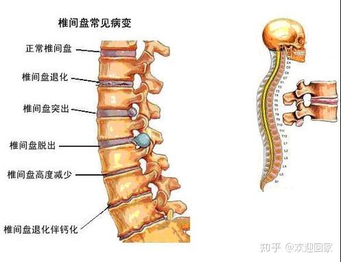 腰椎间盘突出腿疼