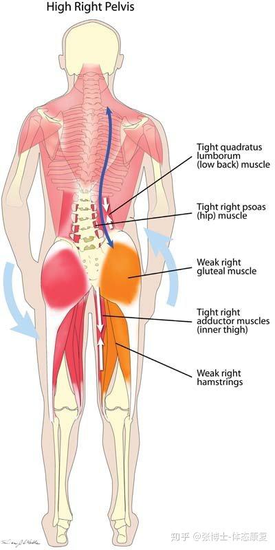 当臀部的一侧比另一侧倾斜得更高,就会造成两侧腰方肌之间的不平衡