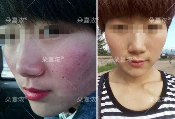 护肤专家王老师激素脸的危害到底有多恐怖