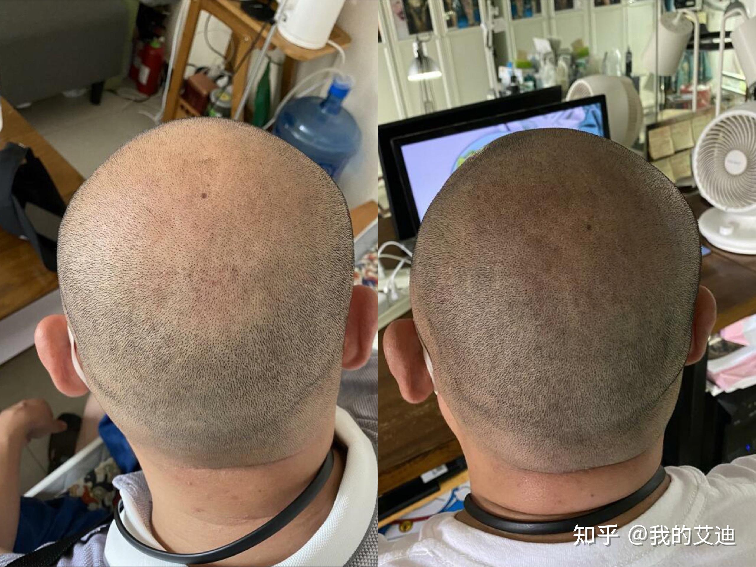 纹发30天以后的样子