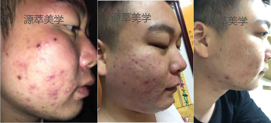体内毒素过多导致的内分泌失调,会引起痘痘,但主要的原因还在于脸颊
