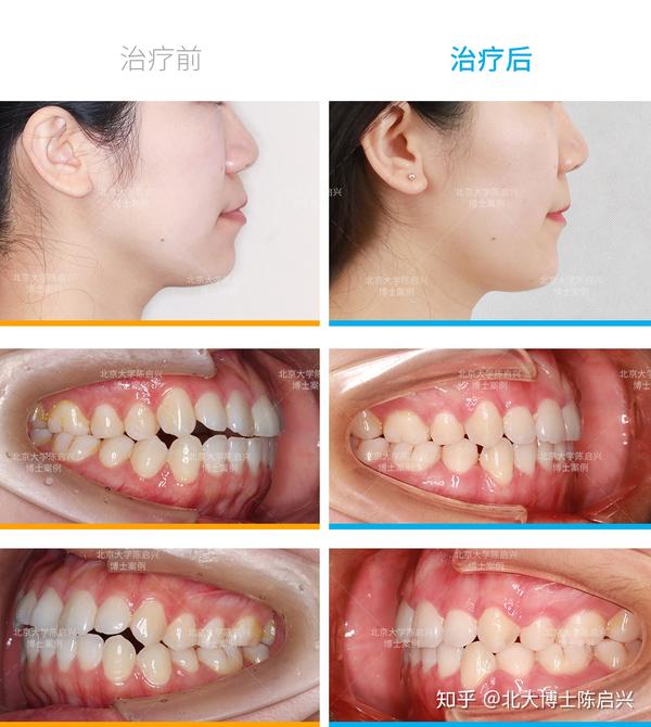 女生嘴突的问题得到改善,拔牙间隙完全关闭,牙齿恢复正常咬合,牙槽基