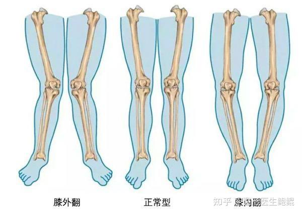 小腿外翻怎么改善腿型不好看夏天很自卑不敢穿短裤