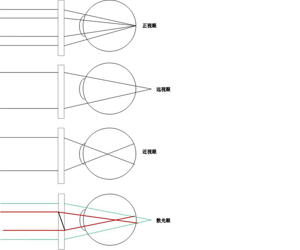 成一个照相机,近视就是光线的焦点成像在底片之前,远视就是底片之后