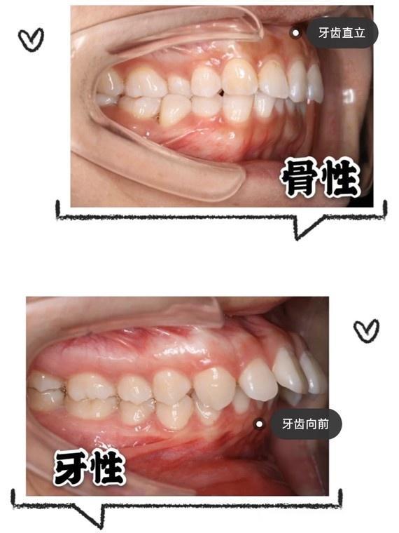 如何判断自己是骨性龅牙还是牙性龅牙?