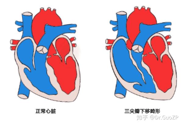 聊聊先天性心脏病三尖瓣下移畸形