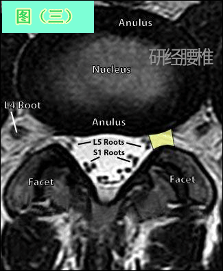 你自己也能看高深的腰椎间盘突出ct和mri磁共振片子【建议收藏】