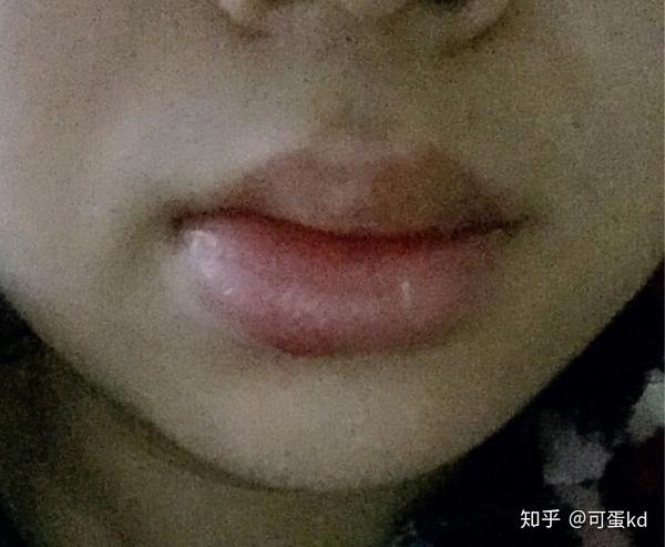 记一次嘴唇痈 - 知乎