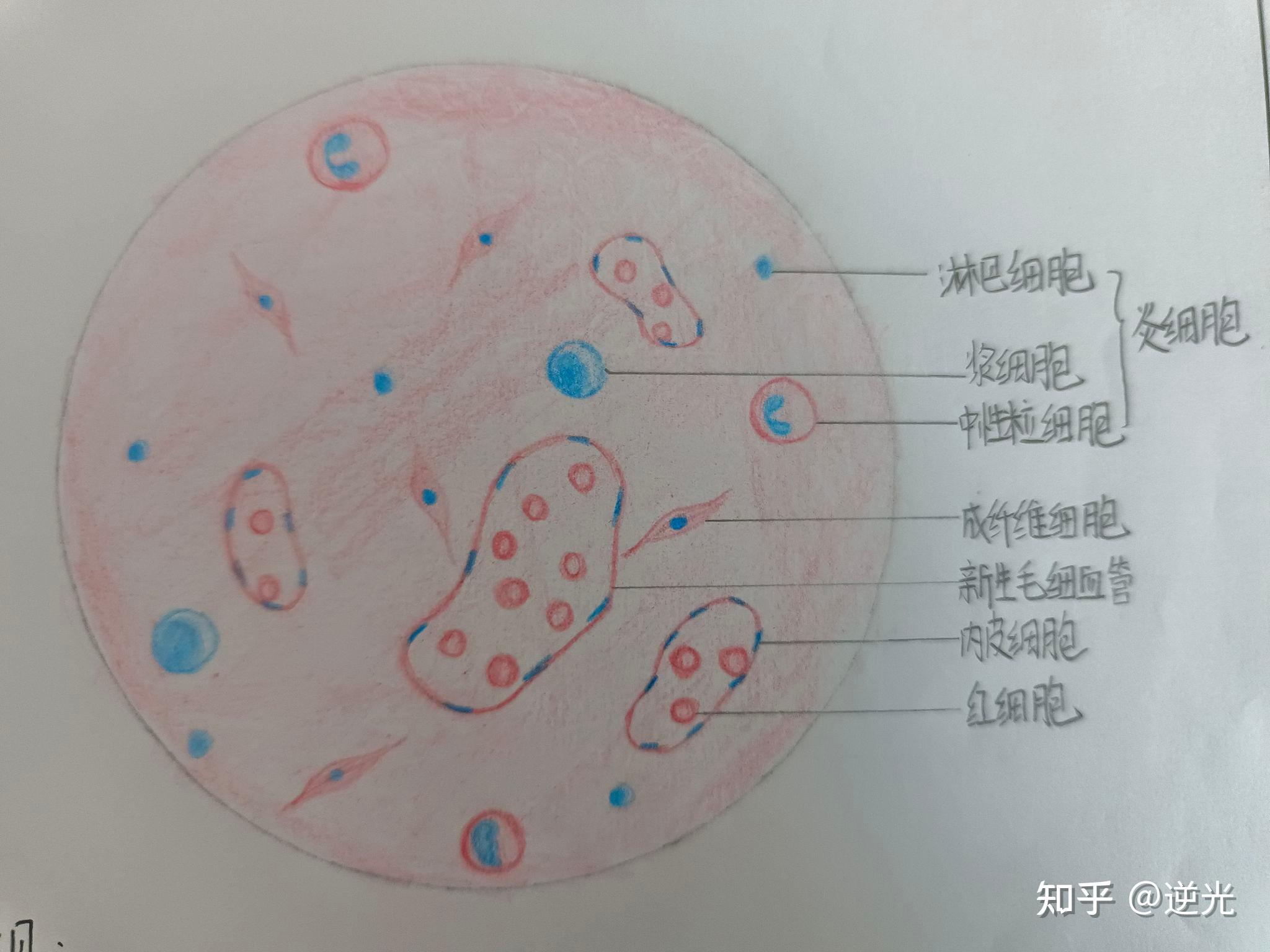 慢性肺淤血手绘图 zhuanlan.zhihu.com