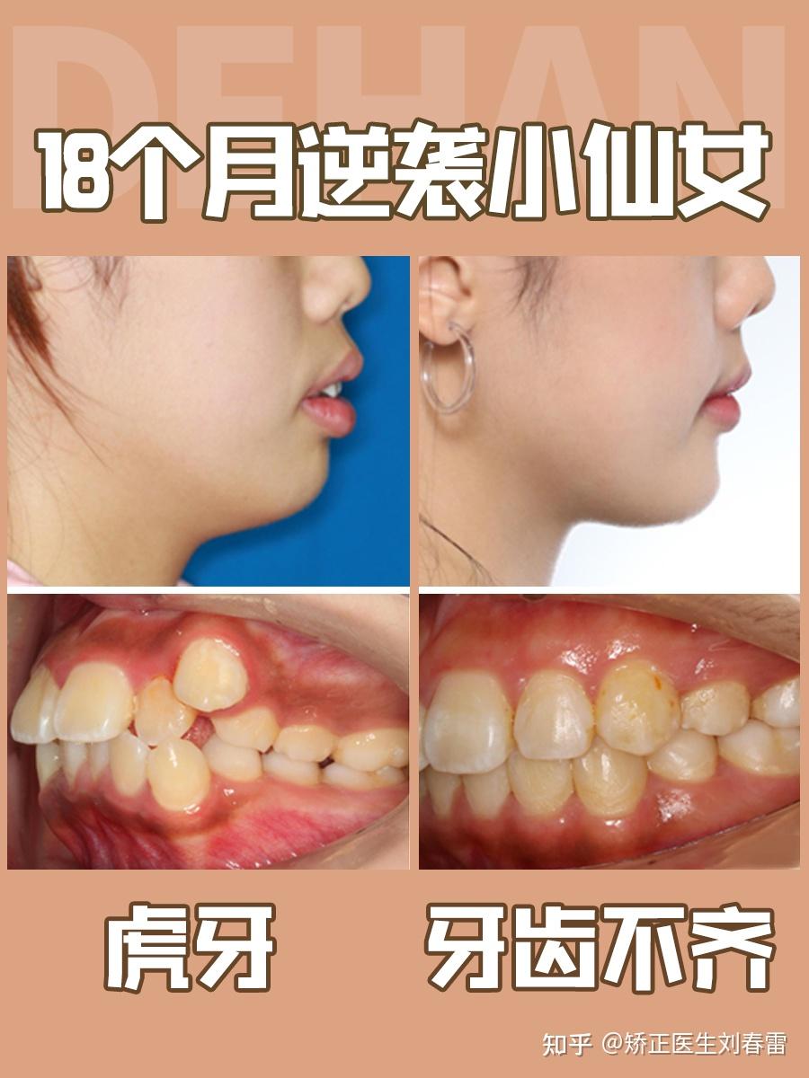 实例解析|有虎牙要不要做牙齿矫正