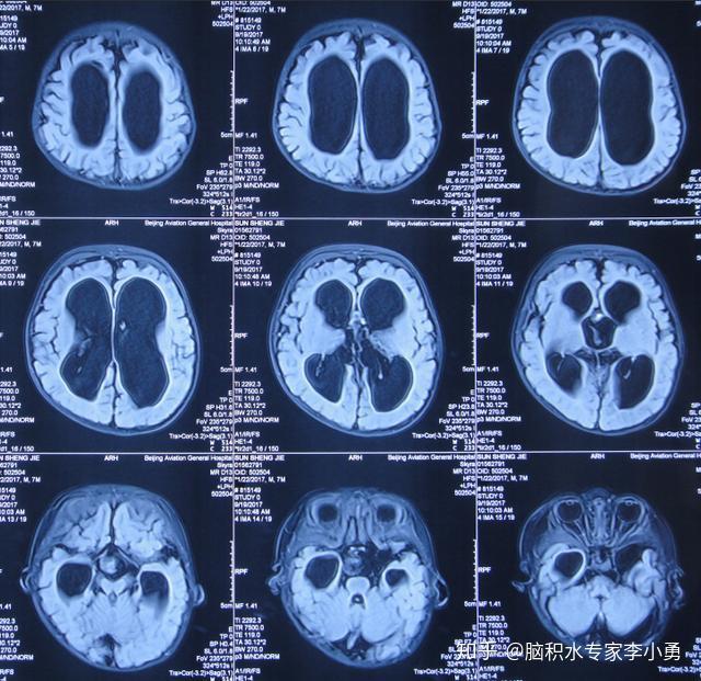 婴儿脑积水鞍上蛛网膜囊肿软性内镜三脑室造瘘术和蛛网膜囊肿造瘘术后