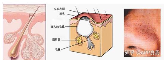 刷酸之后感觉皮肤变皱了毛孔黑头更明显了是怎么回事