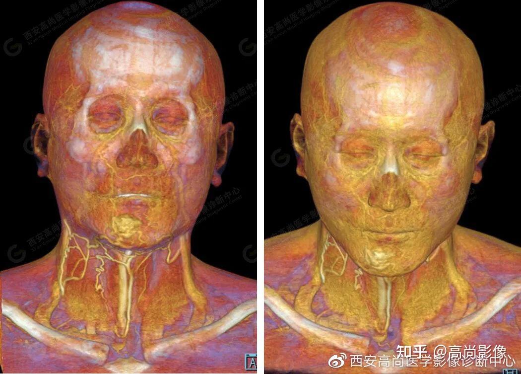 【西安高尚病例】颌面部血管畸形cta,ctv成像技术应用
