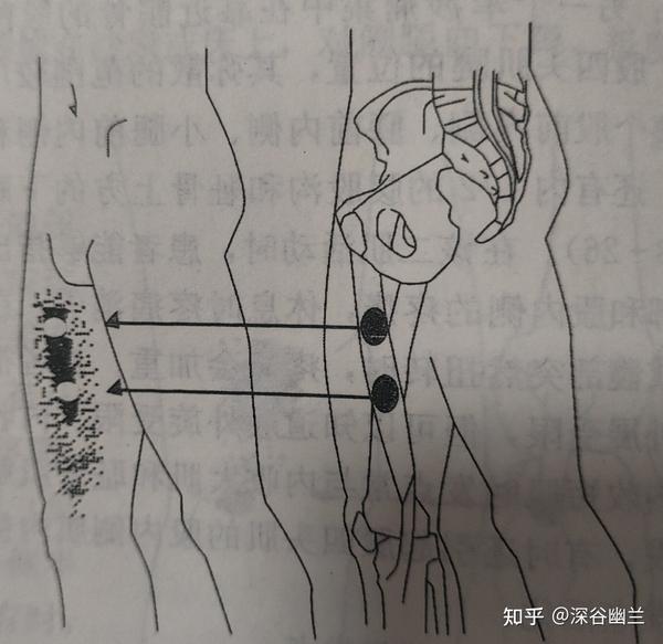股薄肌触发点和其牵涉痛位置
