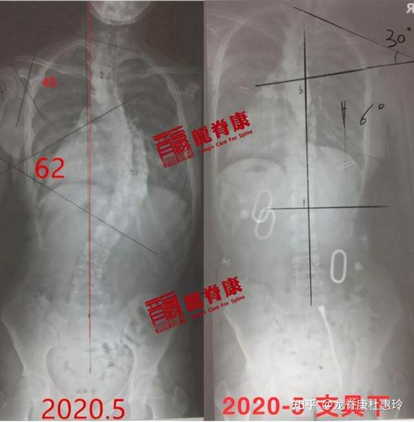 因佩戴支具和训练时间不足,已经减少的度数又反弹7