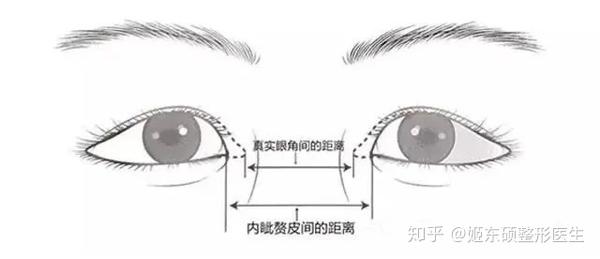 皱襞,它遮掩着我们眼角的位置,使内眦角角度比没有内眦赘皮的眼睛看