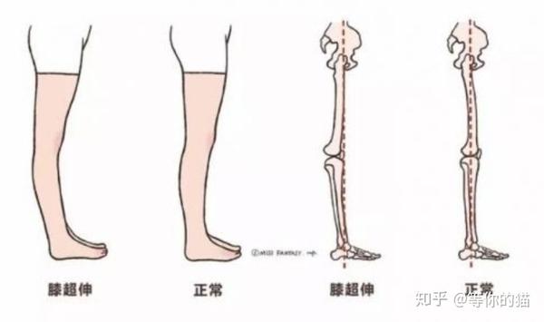 你是xo型腿的哪一种?
