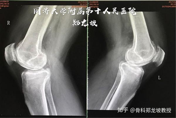 膝关节表面置换手术是根治膝关节骨关节炎的有效方法