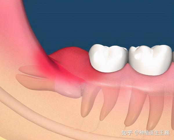 由于多数智齿萌出不全,牙冠的一部分被牙龈包绕,形成盲袋,食物残渣