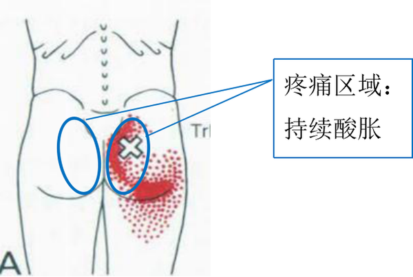 女25岁坐半小时腰骶部及双侧臀部肌肉酸胀不能忍受一年多了并逐渐加重