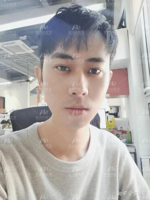  术后七天> 小赵明明只做了眼睛,全像整了全脸一样.