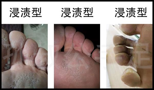 注意:糜烂型脚气是所有脚气类型中最多见的一种,好发于第三与第四,第