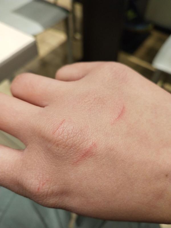 被猫抓划伤手指是否需要注射疫苗?