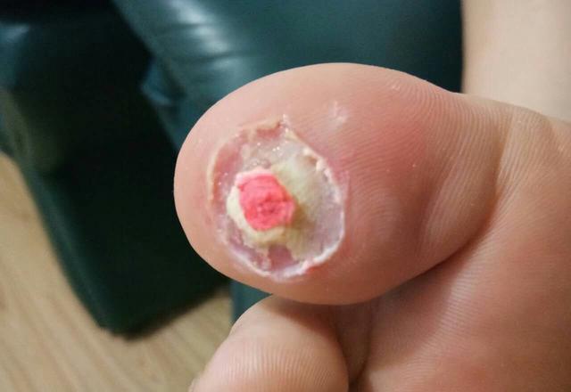 得了鸡眼怎么办 预防鸡眼注意什么?