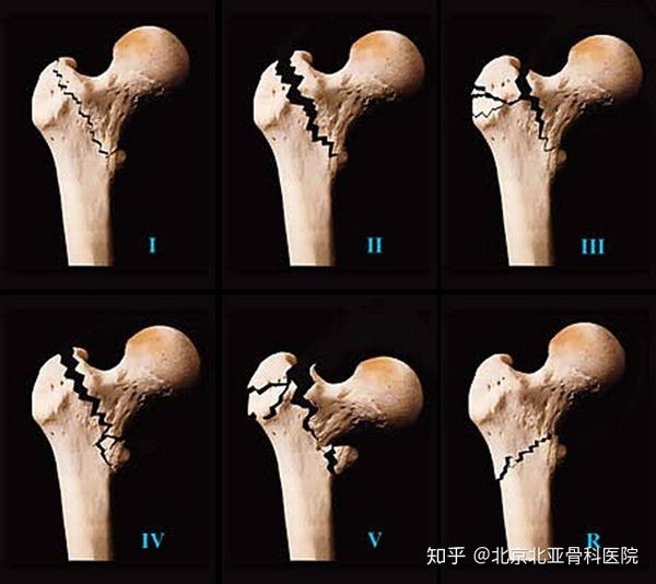 iv型 3部分骨折,由于小转子或股骨矩骨折缺乏内侧支持.