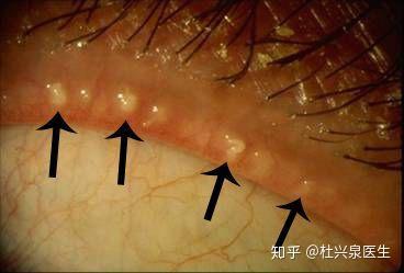 显微镜底下可见睑板腺开口堵塞