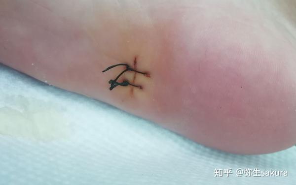 双脚脚底痣的切痣经历