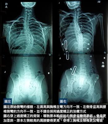 值的医疗脊柱侧弯矫正需要注意的因素