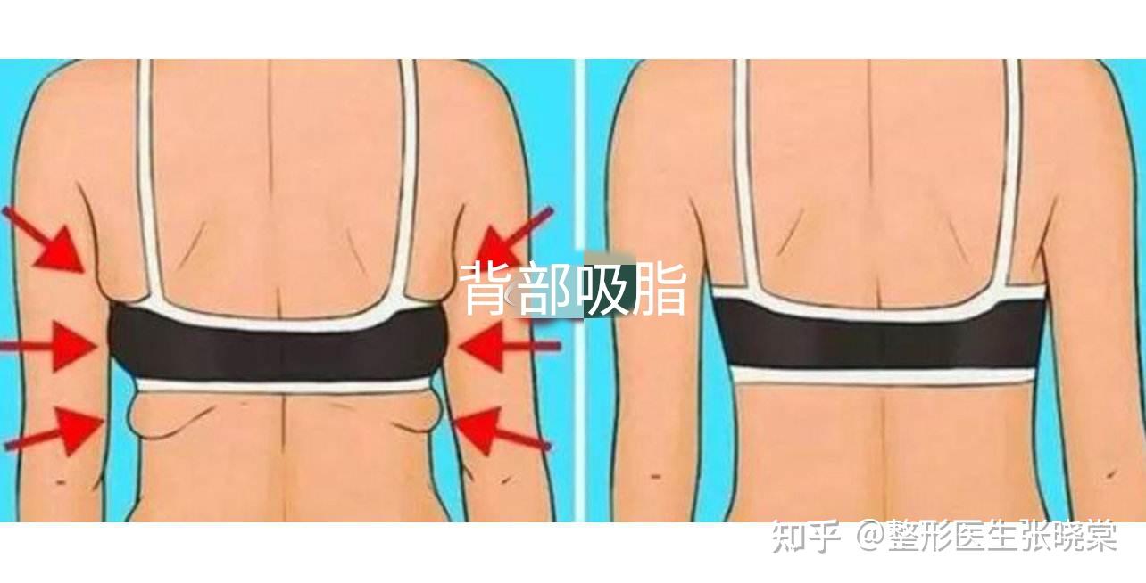 冬天吸脂效果怎么样恢复的好吗
