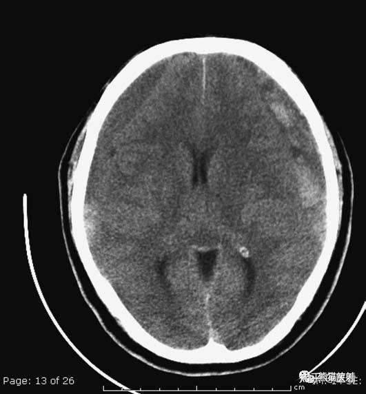 双侧亚急性硬膜下血肿:左侧可见急性出血,双侧占位效应平衡,中线结构