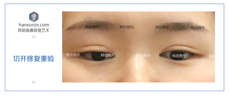 韩勋案例修复切口凹陷调整重睑形态
