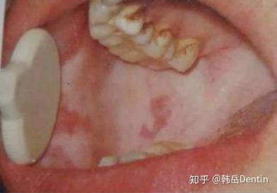 吃槟榔导致的口腔黏膜下纤维化(osf)怎么办?