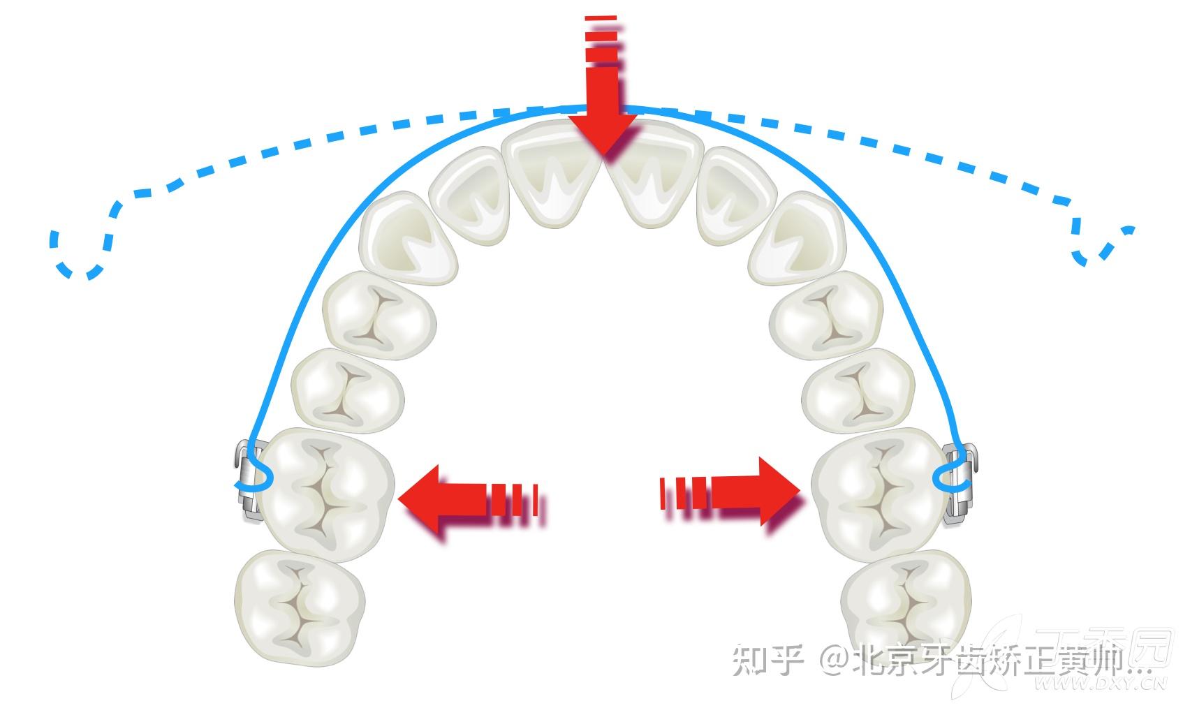 成年人牙齿矫正可以扩弓吗